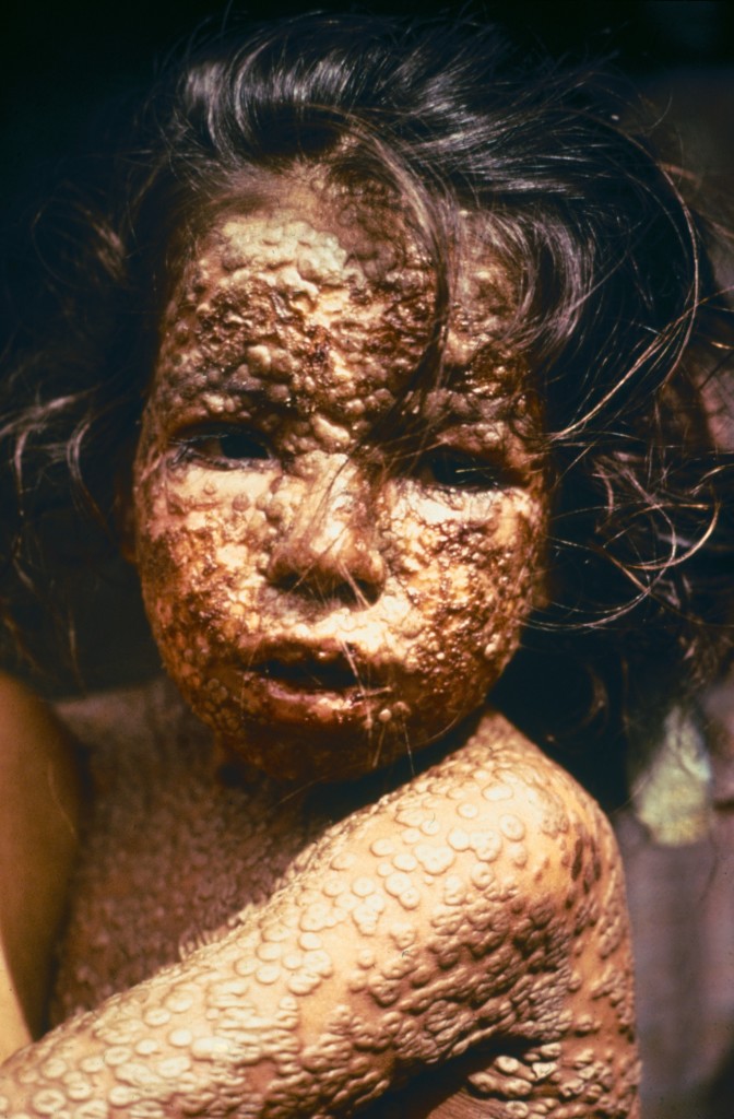 Child_with_Smallpox